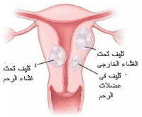 الأورام الليفية الرحمية وتشخيصها والعلاج الدوائي والجراحي لجدار الرحم