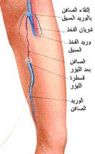 اعراض الدوالي عند الرجال